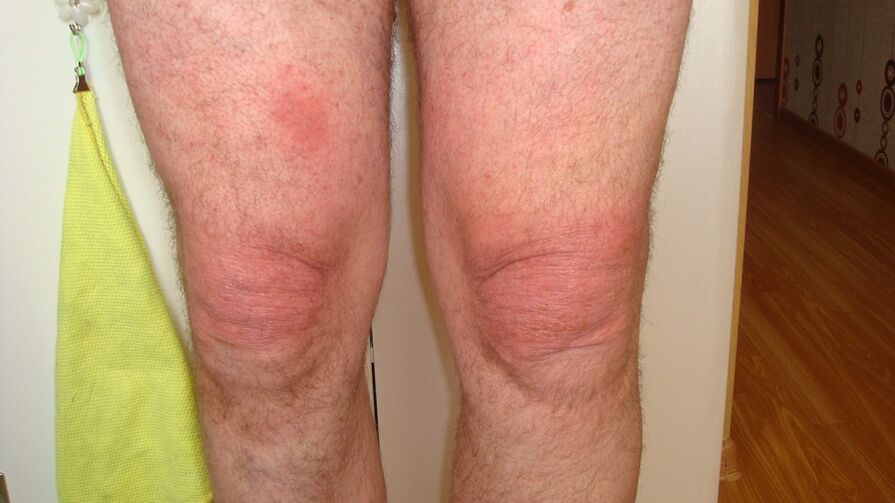 a térdízületek ízületi ízületi